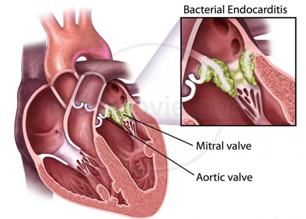 Ảnh 4 của Infective endocarditis